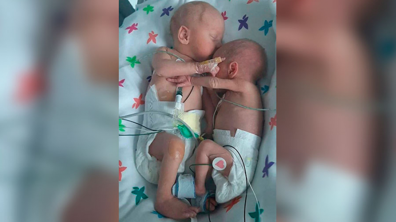 Трогателно: Оцеляла по чудо сестра нежно прегръща своя брат близнак в кувьоза СНИМКИ