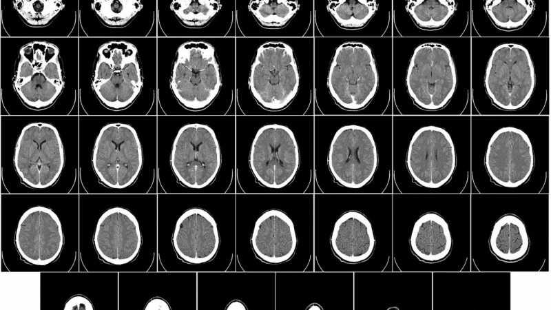 Мистериозна мозъчна болест повали десетки в Канада
