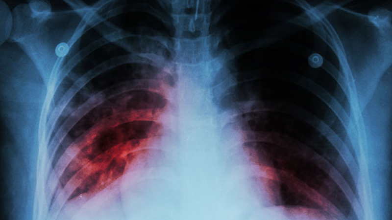 6 мита за туберкулозата