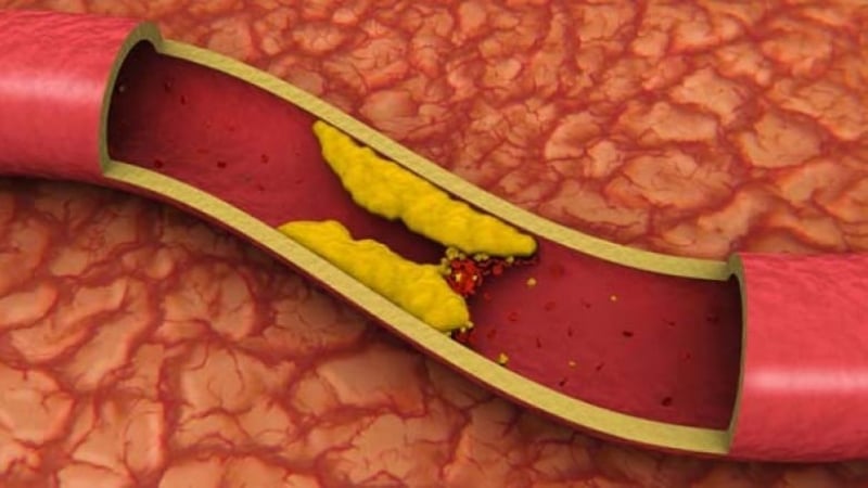 Диетолог обясни как да намалите "лошия" холестерол без лекарства
