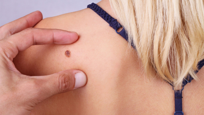 Рак на кожата: Как да разпознаем злокачествената бенка