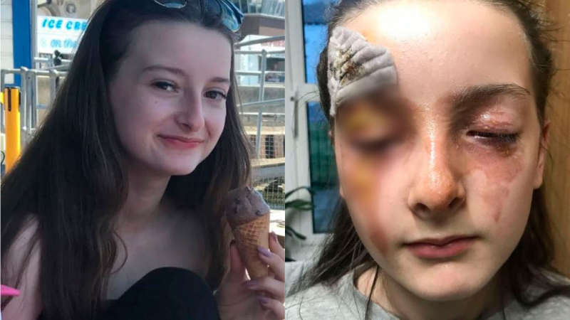 12-г момиче с ужасни изгаряния по лицето, следвайки популярна рецепта от интернет