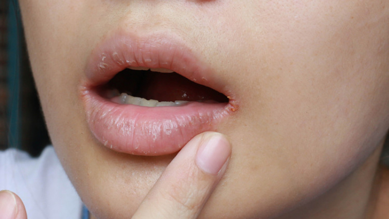 Напуканите устни вещаят опасности за здравето