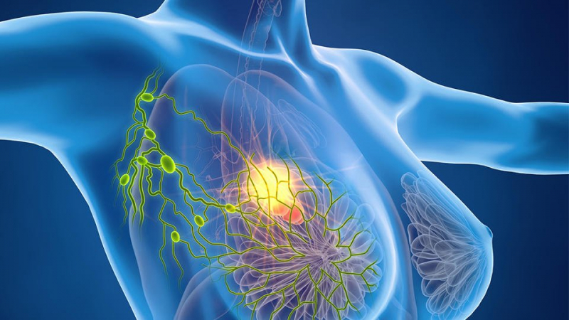 Учени са успели напълно да победят рака на гърдата