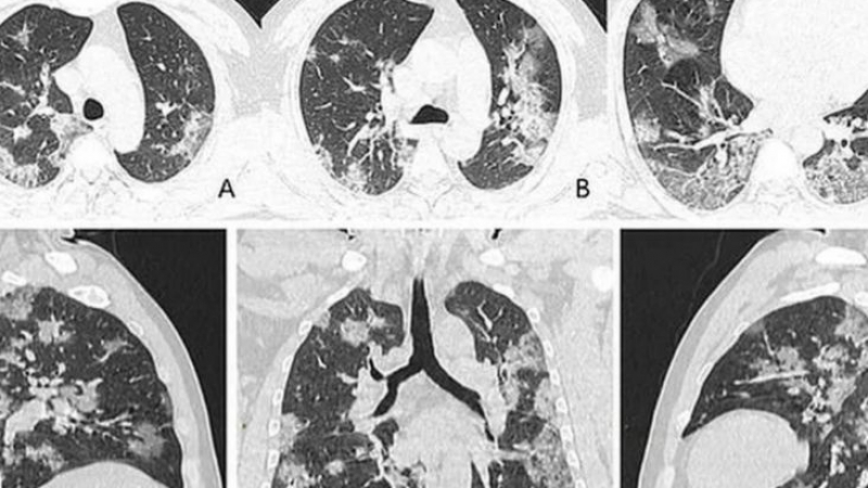 Пулмолог показа страшни СНИМКИ на белите дробове на непълнолетни, заразени с К-19