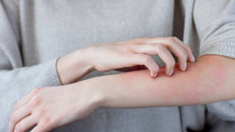 6 кожни симптома алармират за сериозни заболявания