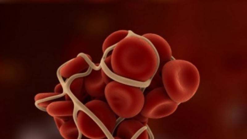 5 признака, че имате образуван кръвен съсирек в тялото