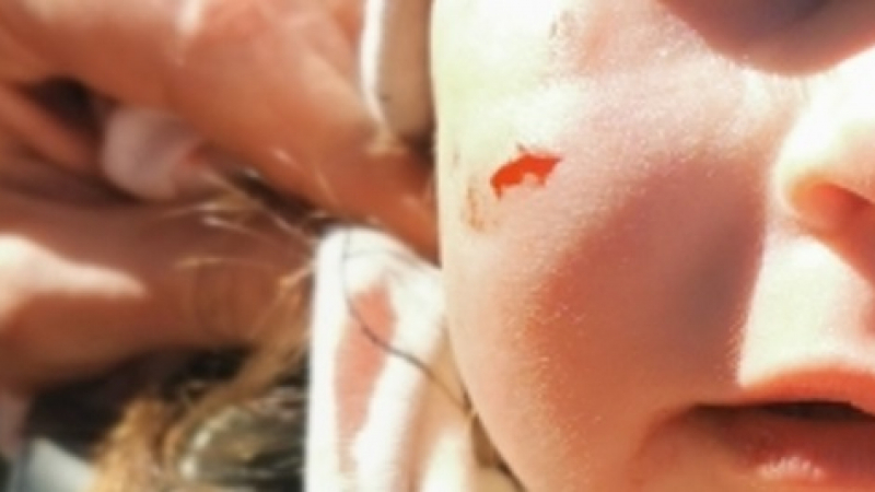 Ужас: Куче нападна дете във Варна и му нахапа лицето СНИМКИ 18+