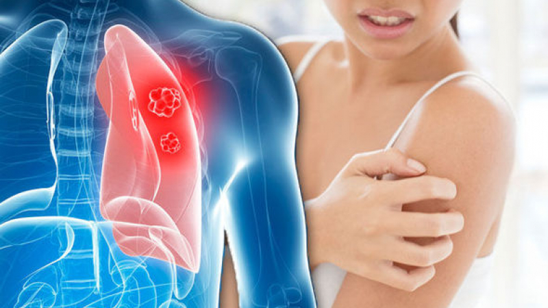 Експерт описа кожните симптоми при рак на белите дробове