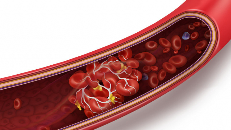 Лекар назова основните 3 фактори за появата на кръвни съсиреци