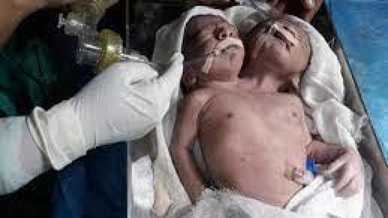Пълен шок! Индийка роди двуглаво бебе с три ръце и... ВИДЕО 