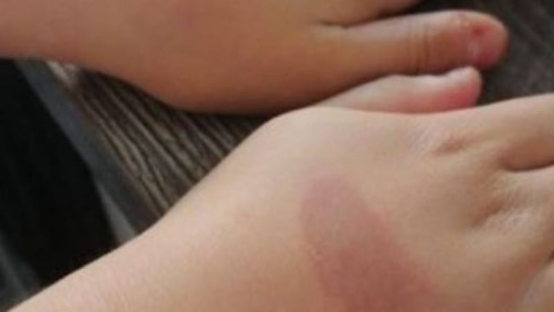 10-г. момиченце пострада след опасно TikTok предизвикателство 