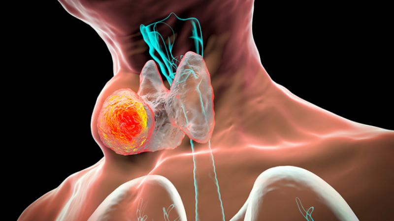 Какво са възлите на щитовидната жлеза и как се лекуват
