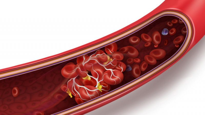Учените посочиха продуктите за предотвратяване на тромбоза