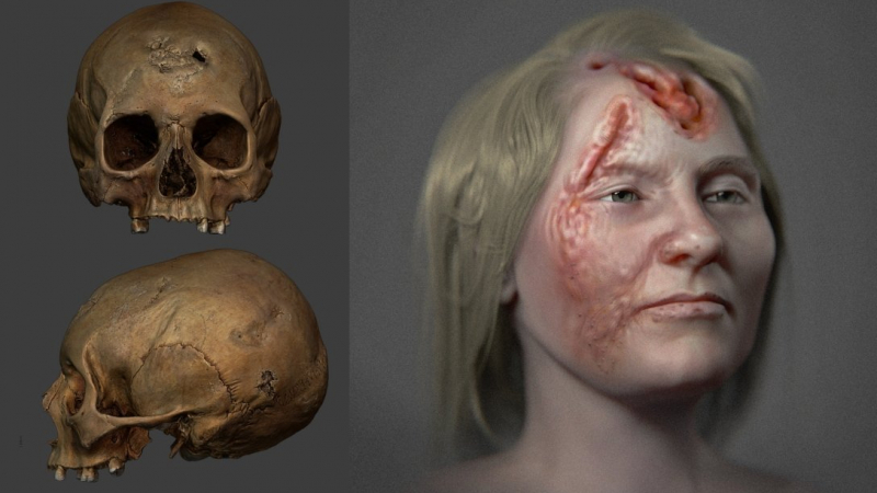 Страшни СНИМКИ: Така е изглеждала болна от сифилис жена, живяла преди 500 г.