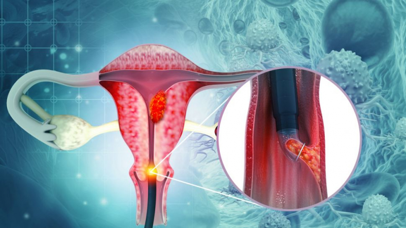 Какво причинява рак на маточната шийка и как да го разпознаем