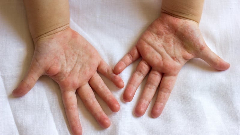 Тези състояния на ръцете ви издават имате ли проблем с черния дроб!