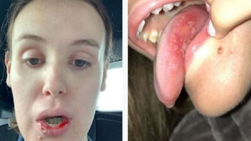 Устата на 19-г. студентка се покри с рани, причината е смразяваща  