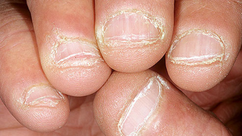 Безотказно! Учени разкриха как се спира гризенето на ноктите