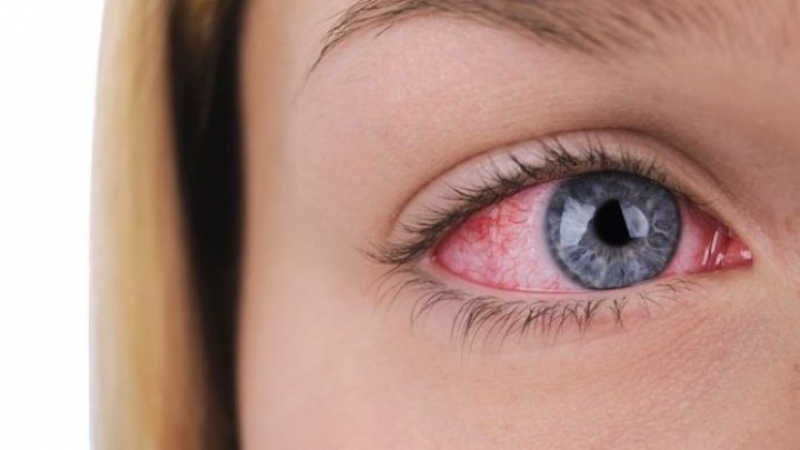 27-г. жена отиде в РСМ и почина от кръвоизлив в окото, причинен от странна треска