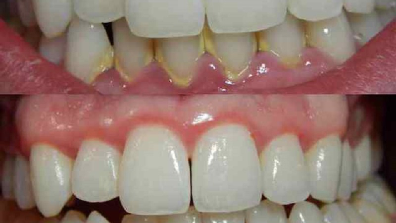 Toп 5 причини за образуване на зъбен камък
