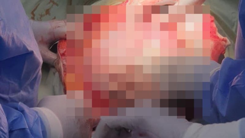 Врачански лекар извади 15-кг тумор от жена и избухна: Човешка глупост! СНИМКИ 18+