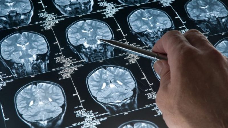 Онколог изброи необичайните симптоми на рак на мозъка
