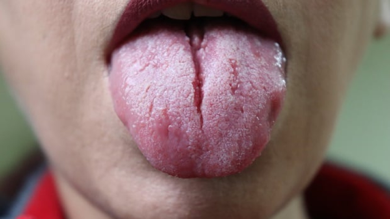 Какво означават браздите по езика за здравето ни