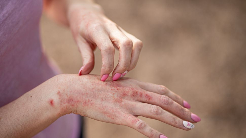 Какво е домакински дерматит и как да го избегнем