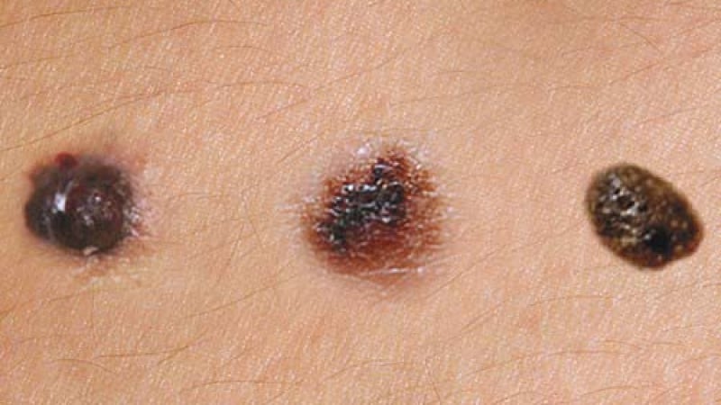 Онколог назова първия симптом за черен рак на кожата