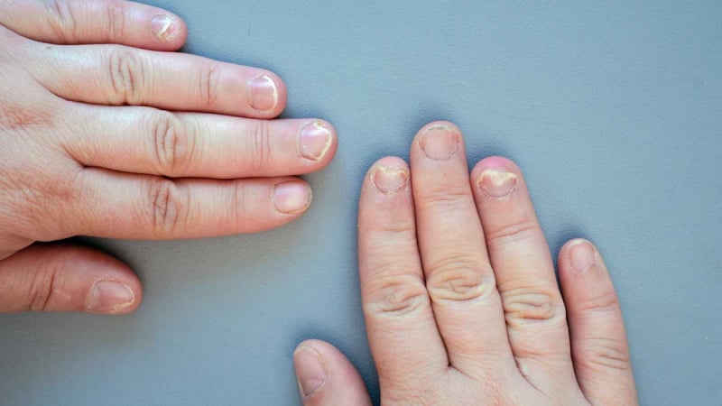 Вижте всички болести, за които сигнализира състоянието на ноктите