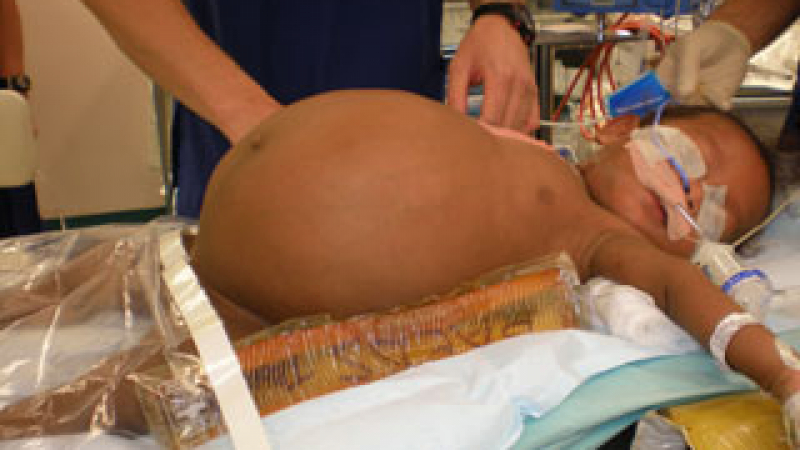 Извадиха 3.3 кг тумор от тялото на 14-месечно бебе 