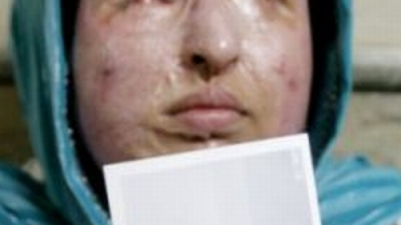 Иранец, ослепил жена с киселина, наказан от съда със същото