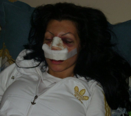 Пребитата от Орлинов показа обезобразеното си лице