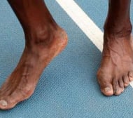 Гъбички и болни нокти по краката на Болт