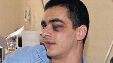 Сръбски хандбалист уцелен със стреличка в окото