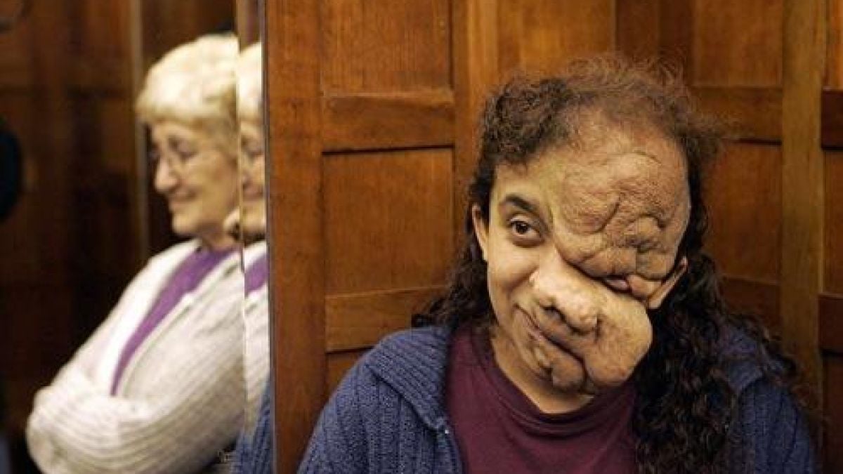 Оперираха туморите, покрили лицето на момиче