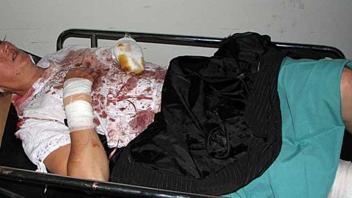 Жена обгоря, гасила пожар с голи ръце 