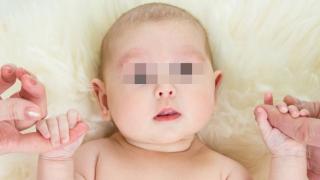 4-месечно бебе оцеля след като извадиха тумор със зъби от мозъка му
