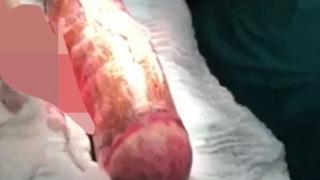 Доктори вадят два часа 46-сантиметрова маниока от задника на мъж- ползвал я като сексиграчка (18+)