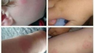 Внимание! Ако забележите нещо такова по кожата на детето си, веднага тичайте при лекаря!     
