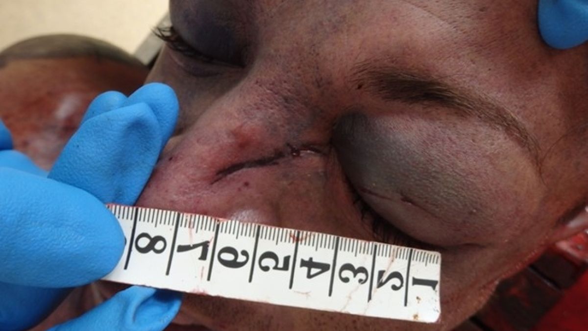Покъртителни СНИМКИ (18+) на трупа на мъжа на Мейзер! Патолози и медици съобщиха шокиращи подробности