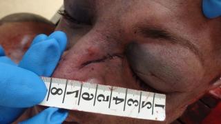 Покъртителни СНИМКИ (18+) на трупа на мъжа на Мейзер! Патолози и медици съобщиха шокиращи подробности