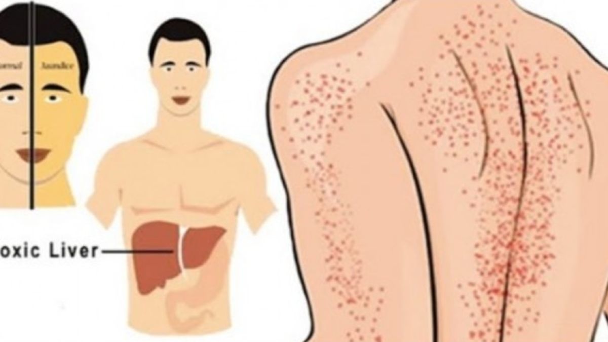 Четири симптома, които ви подсказват, че имате проблеми с черния дроб! Не ги пренебрегвайте никога!