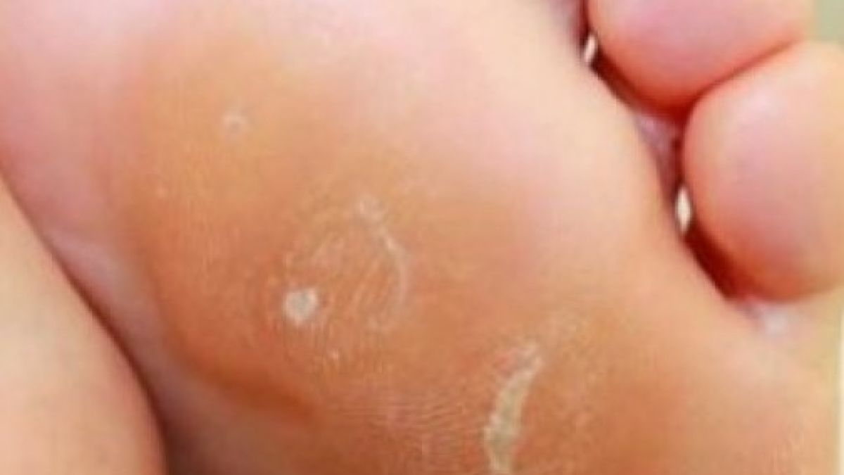 Честото появяване на мазоли води до много коварна болест