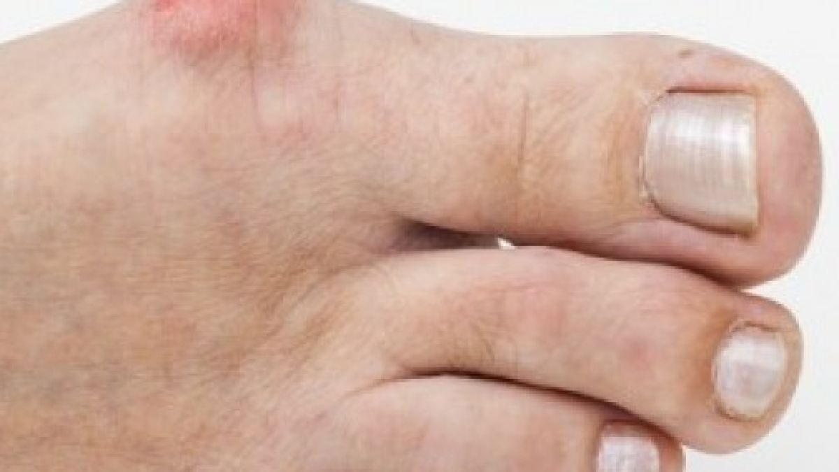 Растежът на костта в областта на палеца е много често срещан проблем, тази рецепта ще ви оправи живота