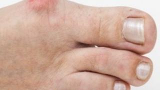 Растежът на костта в областта на палеца е много често срещан проблем, тази рецепта ще ви оправи живота