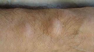 Дерматолозите препоръчват много ефективен начин, с който да се отървете от мастните натрупвания 