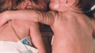 Невероятно чудо преди 18 години! Тази прегръдка завинаги промени медицината! Ето как изглеждат тези близначки днес! (ВИДЕО)