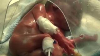 Преждевременно родено момиченце било обявено за мъртво. Малко преди кремацията родителите.... (СНИМКИ/ВИДЕО)